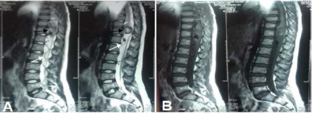 Figure.7 MRI dorsolumbar spine of case (11) (A) T2 sagittal images show an intradural extramedullary lesion (black arrow), central cord hyperintensity, and hypertrophied spinal vessels (white arrow).