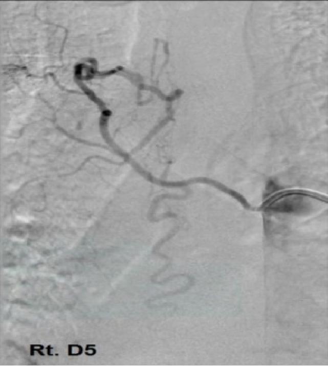 Figure.9: Pre-intervention DSA of case (14) shows: a perimedullary arteriovenous fistula arising from the Rt. D5.