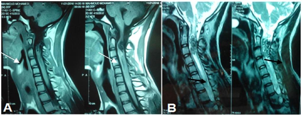 T2 perimedullary signal voids along the spinal cord were seen in 66.7% of patients. Hypertrophied spinal vessels on MRI were seen in 66.7% of patients (figure 3).