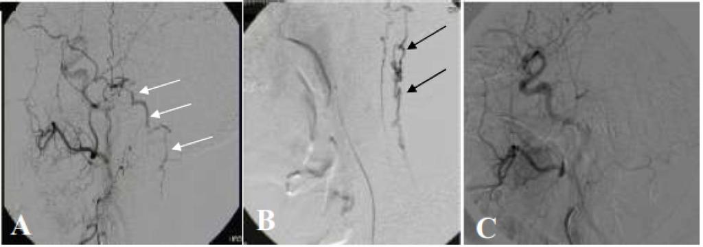 Precise identification of the fistula level is important in both endovascular and surgical treatment. Figure.
