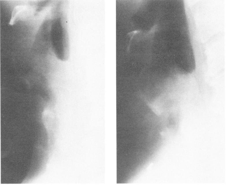58 GRILLOETL nn Thorac Surg 1992;5354-63 Fig 5. Lateral roentgenograms of patient from Figure 4.