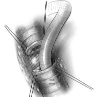 method of ventilation during tracheal resection is: (a) Transtracheal jet