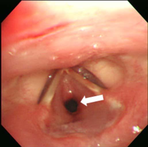 Joo Hyun Jun, et al:airway Management of Subglottic Stenosis A B Fig. 1. Fiberoptic view during (A) rigid bronchoscopy and (B) otolaryngologic exam; image shows focal subglottic stenosis. Fig. 2.
