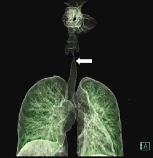 경희의학제 32 권제 1 호 2017 Fig. 3. A 3D computed tomography reconstruction shows a localized area of severe tracheal narrowing (arrow). the narrowest point. Stenosis extended over a distance of 17-20 mm.