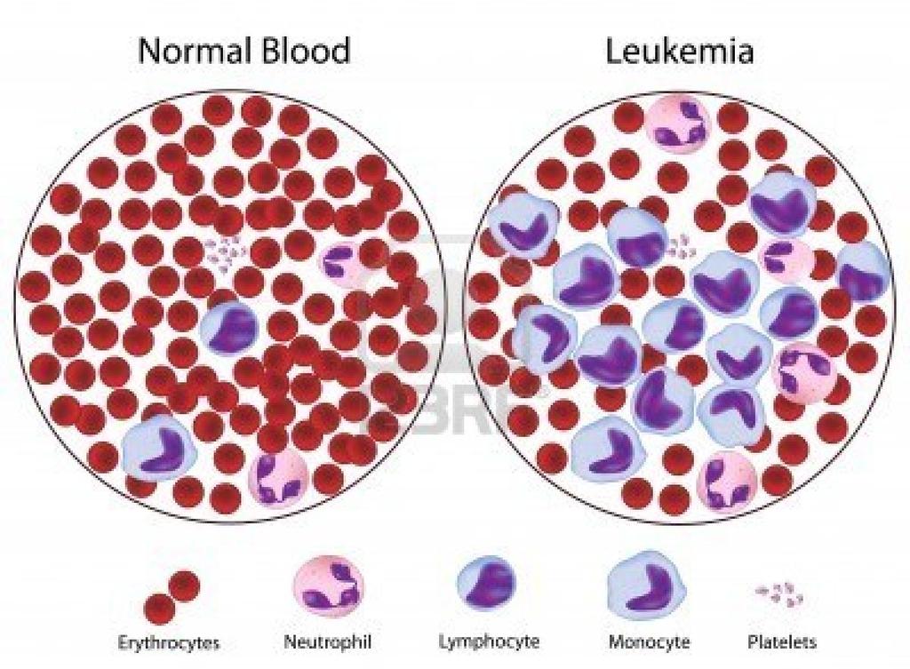 Blood Disorders Leukemia Cancer that affects bone marrow