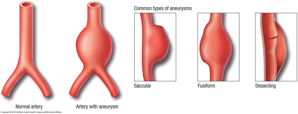 Vascular Disorders Aneurysm Permanent bulge in the wall of a vein, artery, or
