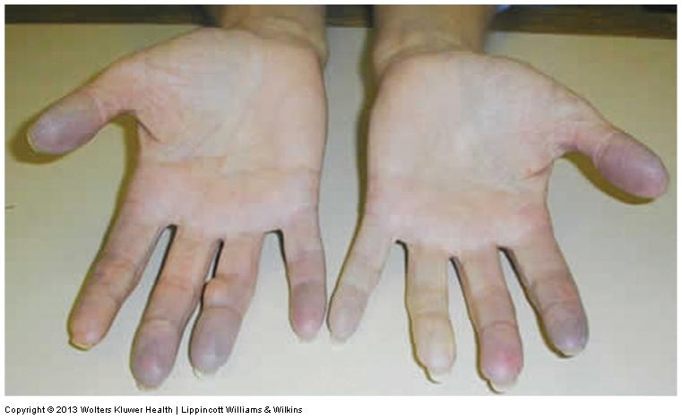 Vascular Disorders Raynaud syndrome Episodes of vascular constriction followed by dilation of