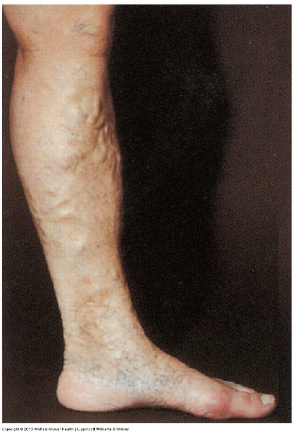 Vascular Disorders Varicose veins Permanently distended superficial