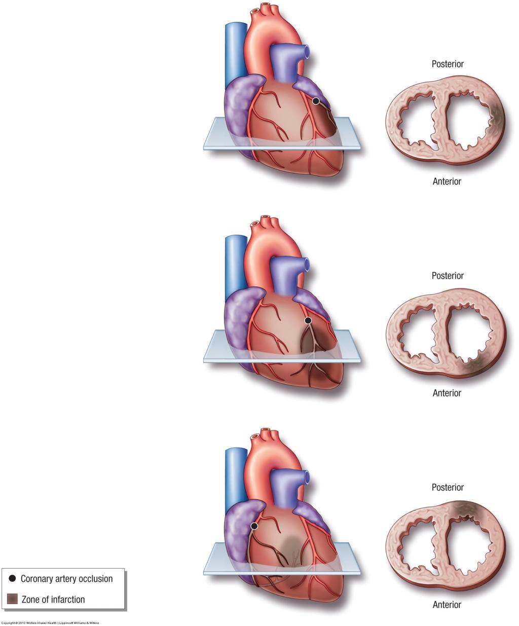 Heart Conditions Heart attack (AKA: myocardial infarction) Damage to the myocardium