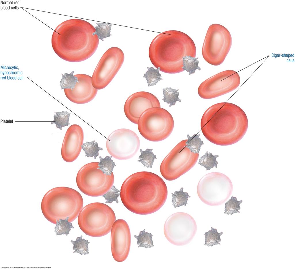 Blood Disorders Anemia Shortage of red blood cells or hemoglobin that limits oxygen carrying