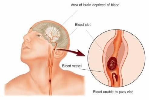 Blood Disorders Embolism The