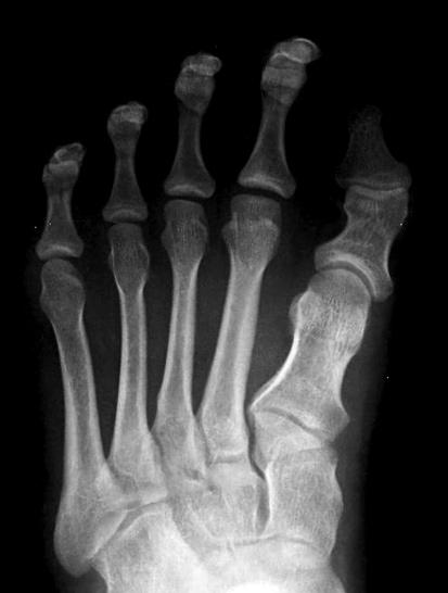 Acta Orthopaedica 2009; 80 (2): 220 225 223 A B C Figure 2. A. Preoperatively: shortening of the first metatarsal. B. Patient undergoing lengthening of the first metatarsal by distraction osteogenesis.