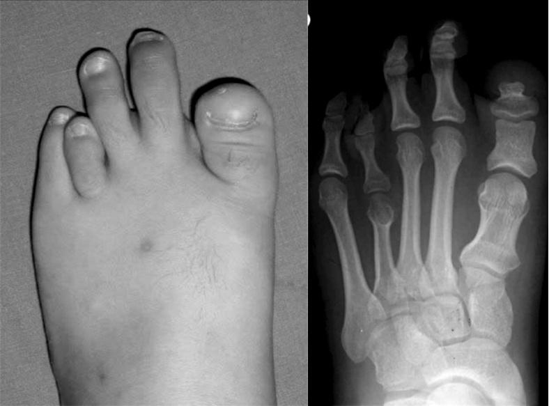 The patient underwent simultaneous lengthening of the first and fourth metatarsal bones by distraction osteogenesis. B.