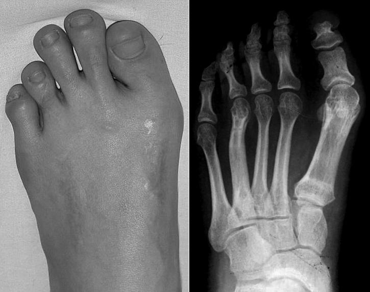A Figure 4. A. Shortening of the first and fourth metatarsals. B.