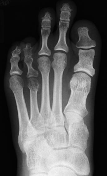 Dorsal closing wedge osteotomies were performed (middle) and the final radiograph (bottom) shows correction of cavus deformity.