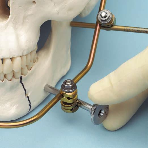 Fixation Using Schanz Screws 11. Add third clamp Attach a third clamp to the rod approximately 10 mm proximal or distal to the defect. Insert the cannula into the clamp, as shown.
