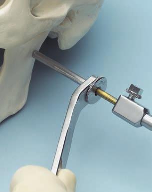 5. Implant Schanz screw With clockwise rotation, insert the Schanz screw through the cannula until the