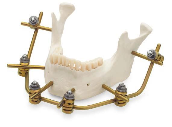 Intended Use, Indications, Contraindications, General Adverse Events Intended use The Mandible External Fixator II is indicated to stabilize and provide treatment for fractures of the maxillofacial