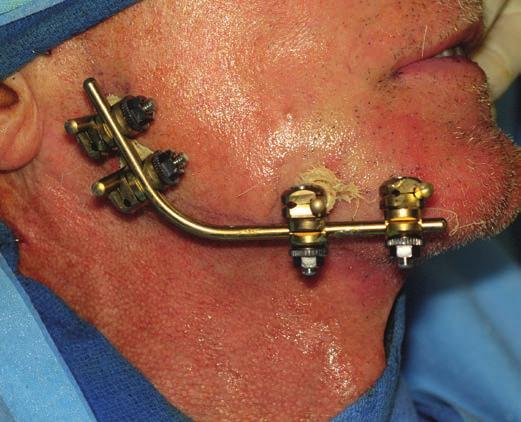 comminuted closed fractures Nonunions and delayed unions (especially associated with infection) Fractures associated with infection Tumor resections Facial deformity corrections Gunshot wounds