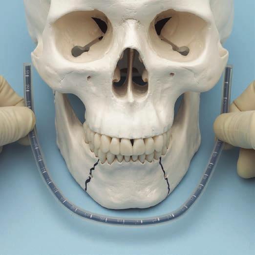 Fixation Using Schanz Screws 1. Patient preparation Place the patient in maxillomandibular fixation when appropriate. 2.