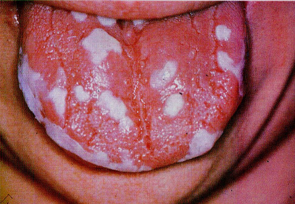 Candida Albicans infection in diabetic patiens The upper lobe of Parotid gland excrete the saccharose from