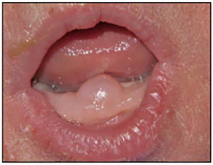 leaving an erythematous base. Diffuse painful erythematous mucosa is another common presentation. A wide variety of topical and systemic antifungal agents are used for management.