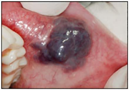pain, decreased serum sodium, and hypotension. Diffuse pigmentation of skin and oral mucosa typically occur in Addison disease.