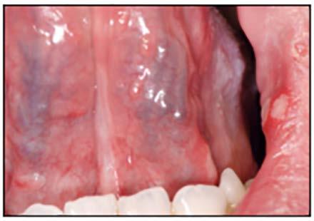 Localized Pigmented Surface Lesions of Oral Mucosa Localized pigmented surface lesions are divided into 4 categories based on their cause and clinical features.