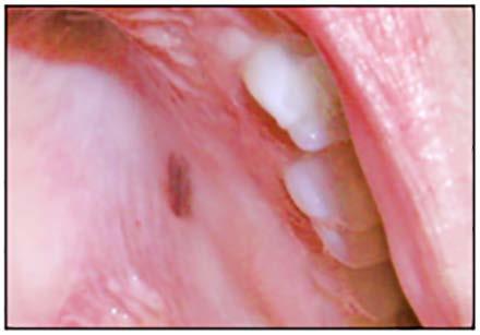 irritated or are a cosmetic problem. Nevi of oral mucosa are relatively rare. They occur most commonly on the gingiva and hard palate.