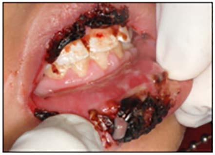 with the buccal mucosa commonly involved. Oral lesions may occur without skin lesions. Asymptomatic lesions require no treatment other than inspection during annual dental visits.