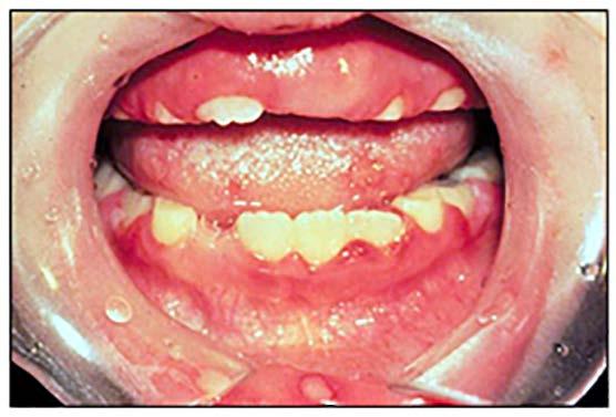 diagnosed based on the clinical features and a history of cinnamon exposure. The lesions typically resolve within one week following discontinuation of the cinnamon products.