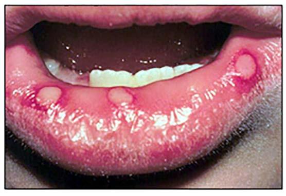 Images of Primary Herpetic Gingivostomatitis: Erythroplasia (erythroplakia) is a clinical term corresponding microscopically to epithelial dysplasia, carcinoma in situ*, or superficially invasive