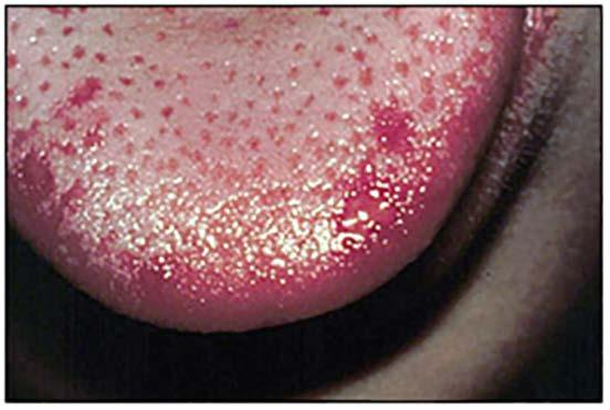 Primary Herpetic Gingivostomatitis Herpes Labialis Recurrent Herpetic Lesion A number of systemic and topical antiviral drugs are available for patients needing treatment.