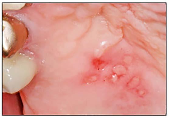 Recurrent herpes has vesicles and ulcers occurring on keratinized mucosal surfaces. The lesions are grouped in a tight cluster.