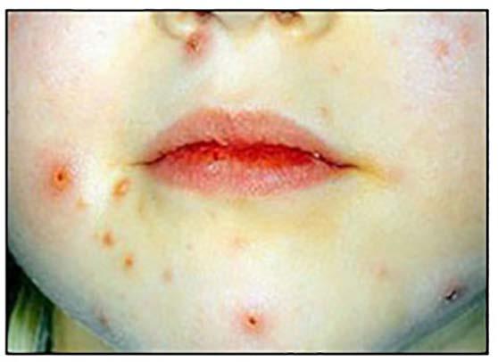 Varicella (chickenpox) Herpangina Herpes zoster Neuralgia in the prodrome stage of zoster is followed by vesicles and ulcers similar in appearance to those caused by herpes simplex.