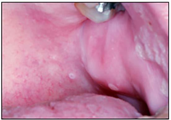 Oral lesions include vesicles and ulcers of the posterior oral mucosa, especially the soft palate and tonsillar pillar areas.
