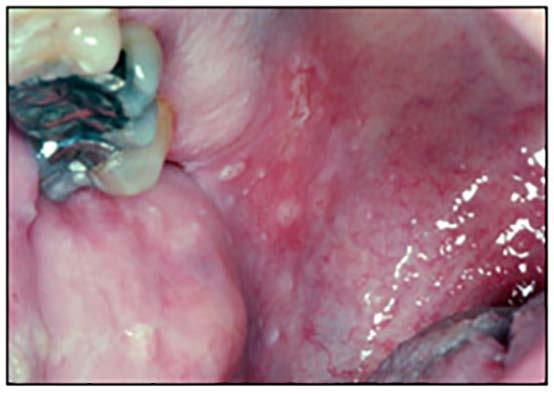 Herpangina Hand, foot and mouth disease* is an infection caused by Coxsackievirus A or B. It has abrupt onset of mild fever and pharyngitis.