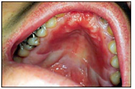 Candidosis (Candidiasis) Chronic Atrophic Candidosis Candidosis can occur in a variety of clinical forms: Pseudomembranous (thrush): White plaques which rub off leaving an erythematous base.