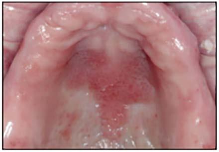 occurs on the hard palate or mandibular alveolar mucosa underneath a denture. The surface of the lesion is bumpy, nodular, or velvety, and often erythematous.