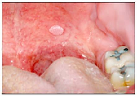 The patient should remove the denture as much as possible, and the lesion should be reevaluated. If the papillary overgrowth is minimal, the lesion does not need to be removed.