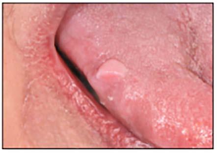 Condyloma acuminatum Benign Mesenchymal Tumors of Oral Mucosa For purposes of this discussion, mesenchymal tumors are composed of fibrous connective tissue, smooth muscle, skeletal muscle, blood and