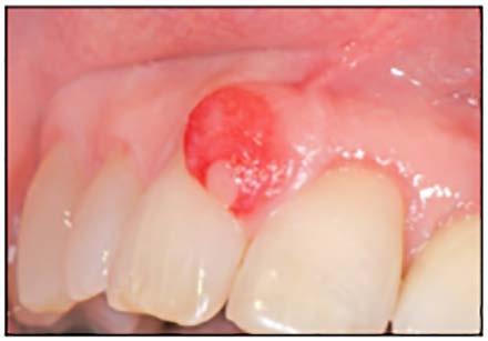 red or have a normal mucosal color. It is most common in adolescents through young adults.