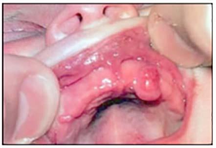 these lesions occur in females. Treatment is surgical excision and microscopic diagnosis. Prognosis is excellent.