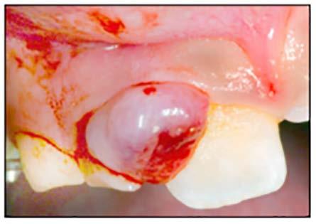 fibroma as discussed above. A vascular soft tissue enlargement is red, blue, or purple and blanches upon pressure.