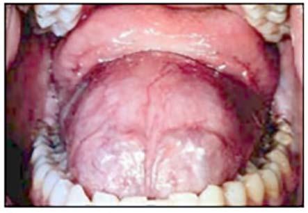 It typically presents as a slowly growing well circumscribed lesion that can be confused with a benign tumor. Adenoid cystic carcinoma* is an adenocarcinoma of salivary gland origin.