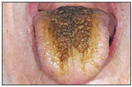serious condition, but warrants treatment for cosmetic and hygienic reasons. Treatment involves using a toothbrush, tongue blade, or tongue scraper to brush or scrape the dorsal surface of the tongue.