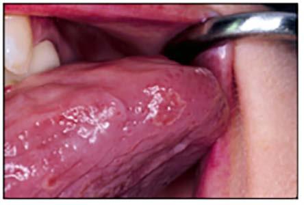 Hairy tongue Erythema migrans Nicotine stomatitis White sponge nevus Hairy leukoplakia is caused by Epstein-Barr virus and presents as unilateral or bilateral, asymptomatic, white, rough patches,