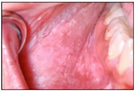 It presents as multiple red patches surrounded by a thickened, irregular, white border. A lesion will resolve in one area and appear in other areas (migrate).