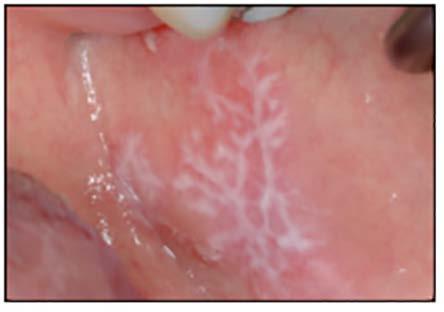 thickened and folded. The most common location is the buccal mucosa bilaterally, but other oral mucosal areas may be involved. Nasal, pharyngeal, and anogenital mucosa may be affected.