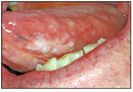 The term leukoplakia refers to a clinically white mucosal thickening lesion that cannot be further defined.